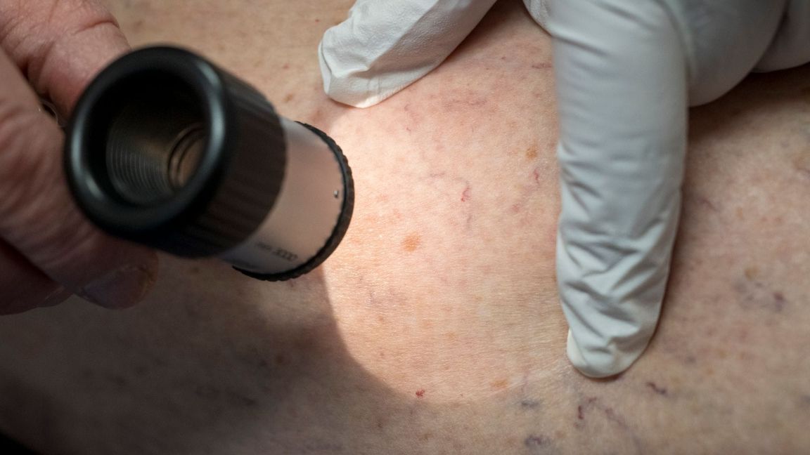 Die Zahl der Krankenhausbehandlungen von Hautkrebs stieg enorm an. (Symbolbild)