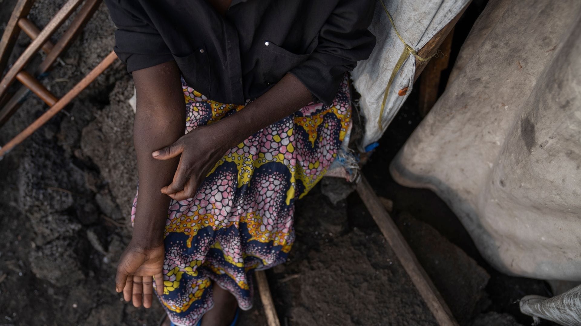 In Afrika gibt es schon 14.000 Mpox-Verdachtsfälle.