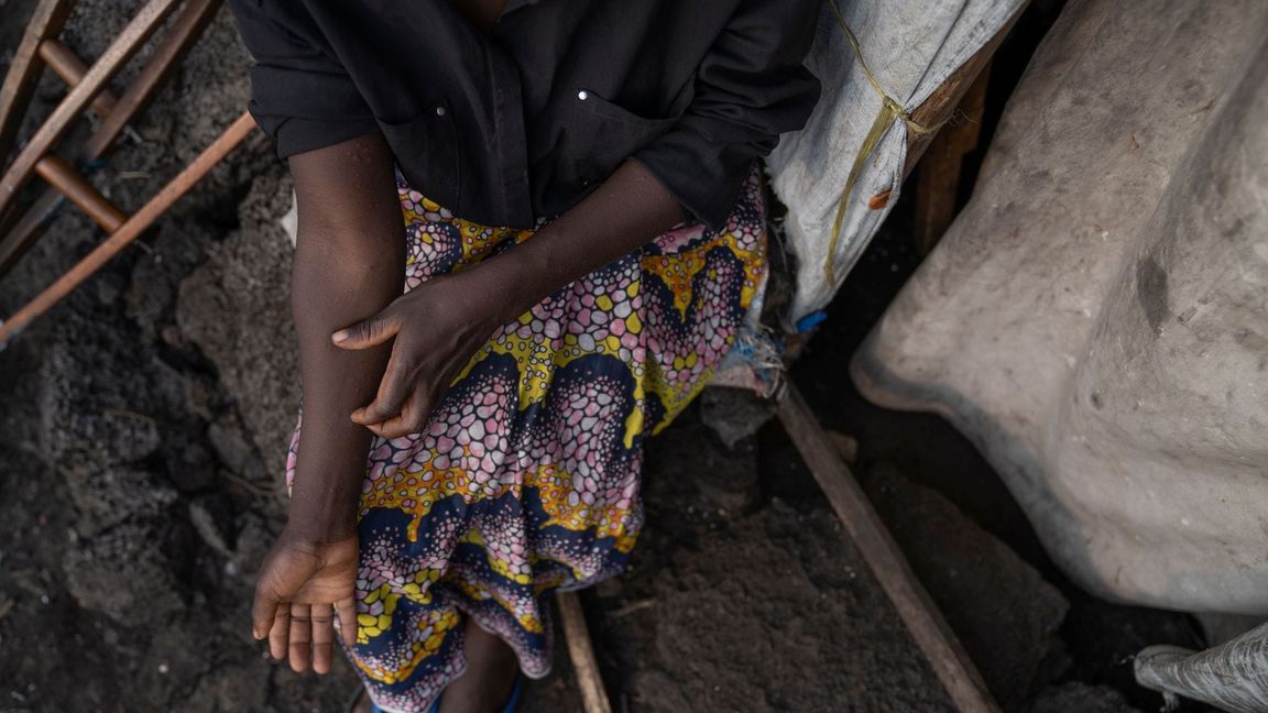 In Afrika gibt es schon 14.000 Mpox-Verdachtsfälle.