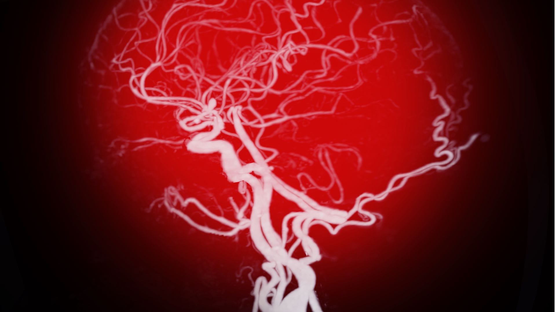 Ein Aneurysma ist eine mit Blut gefüllte sackartige Ausstülpung einer Arterie, die plötzlich aufreißen kann. Die meisten Aussackungen bilden sich an der Hauptschlagader (Aorta), der Herzwand oder im Gehirn