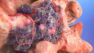 Zell-Mutation und -Entartung: Eine Krebszelle (dunkelviolett) breitet sich in gesundem Gewebe aus und befällt dieses.