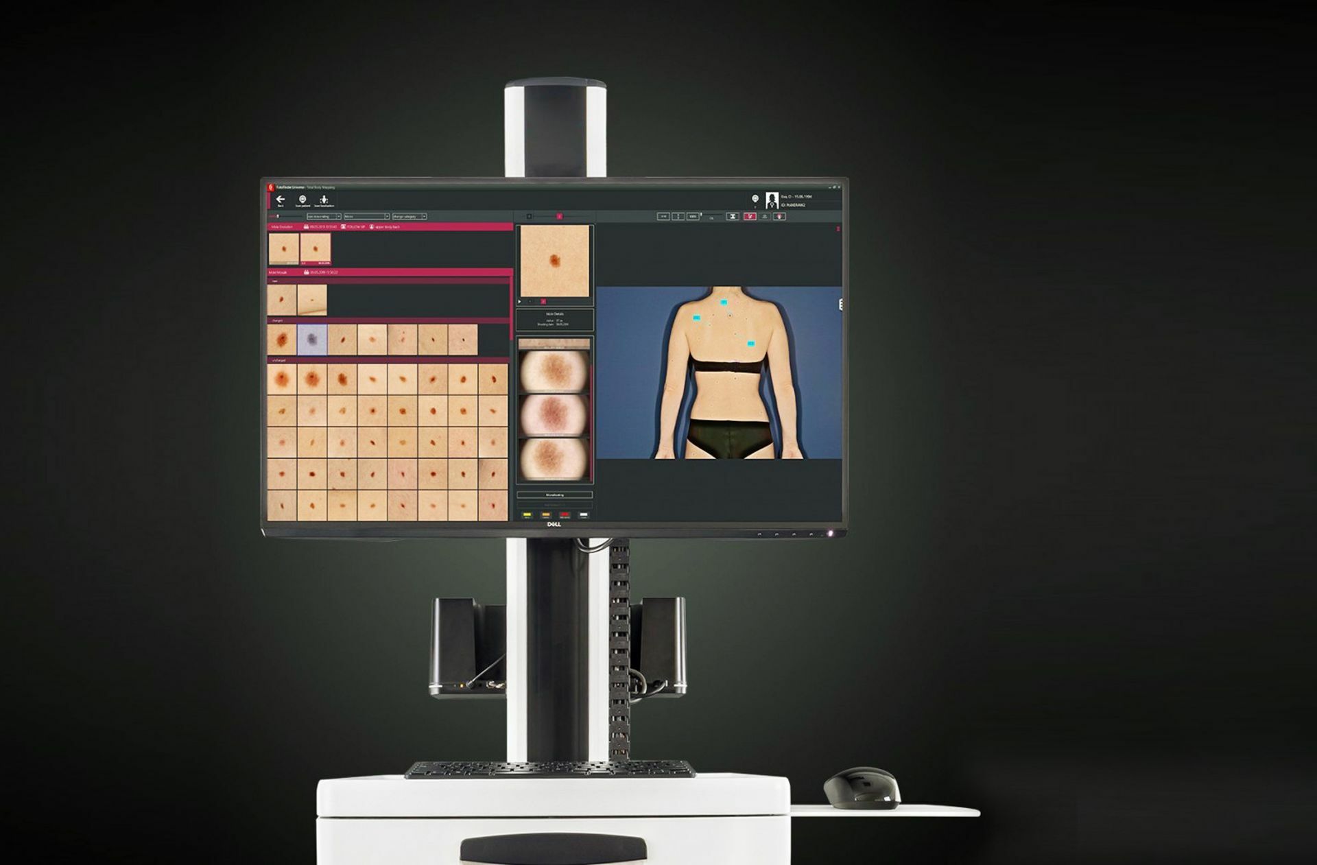 Aufnahmen mit einer Spezialkamera können vom Computer verarbeitet werden. So lassen sich beispielsweise  Muttermale untersuchen.
 Foto: Fotofinder