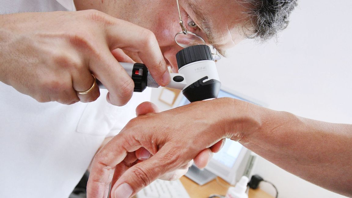 Die Zahl der Hautkrebs-Diagnosen ist in Baden-Württemberg deutlich gestiegen.