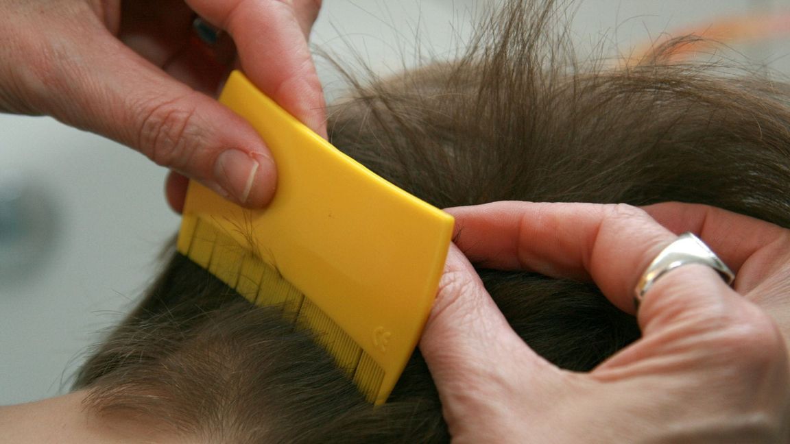 Der Lausbefall bei Kindern im Südwesten ist stark angestiegen. (Symbolbild)