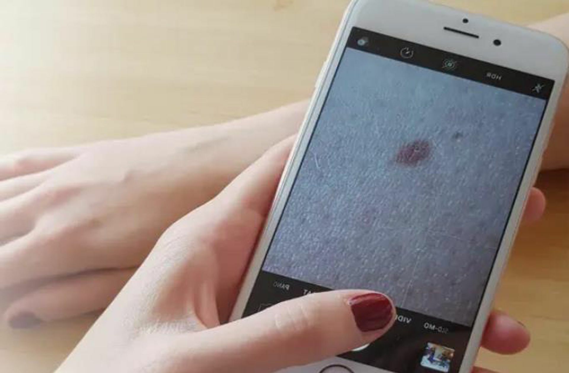 Nutzer können Bilder von Hautstellen hochladen und beurteilen lassen. Je nach Anbieter werden die Fotos mit Algorithmen oder durch Dermatologen analysiert.