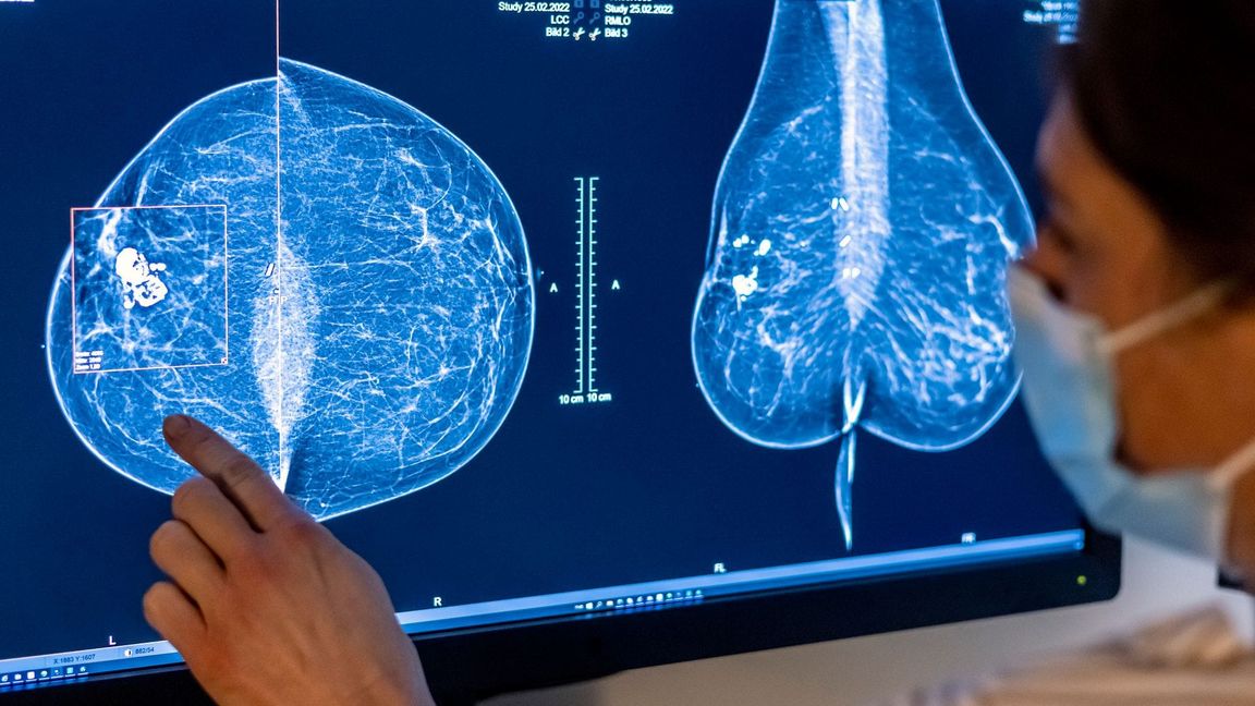 Für Frauen gibt es eine spezielle Untersuchung, um Krebs früh zu entdecken: die Mammografie. (Archivbild)