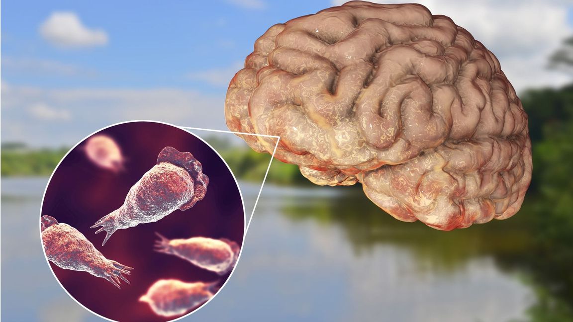 Wenn die Parasiten etwa beim Schwimmen in die Nase eines Menschen gelangen, können sie entlang des Riechnervs ins Gehirn vordringen und dort eine eitrige Hirnhautentzündung hervorrufen.