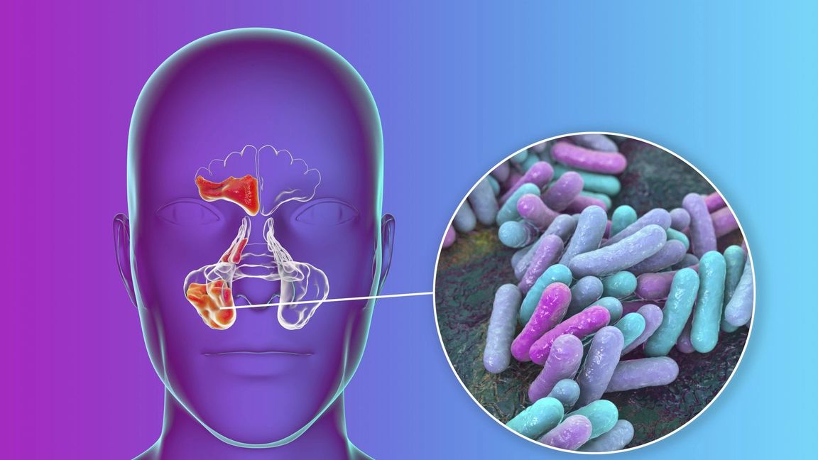 HIB steht für Haemophilus influenzae Typ b, ein Bakterium, das schwere Infektionen, insbesondere bei Kindern, verursachen kann. Zu den möglichen Erkrankungen gehören bakterielle Hirnhautentzündung (Meningitis) und Kehldeckelentzündung (Epiglottitis).