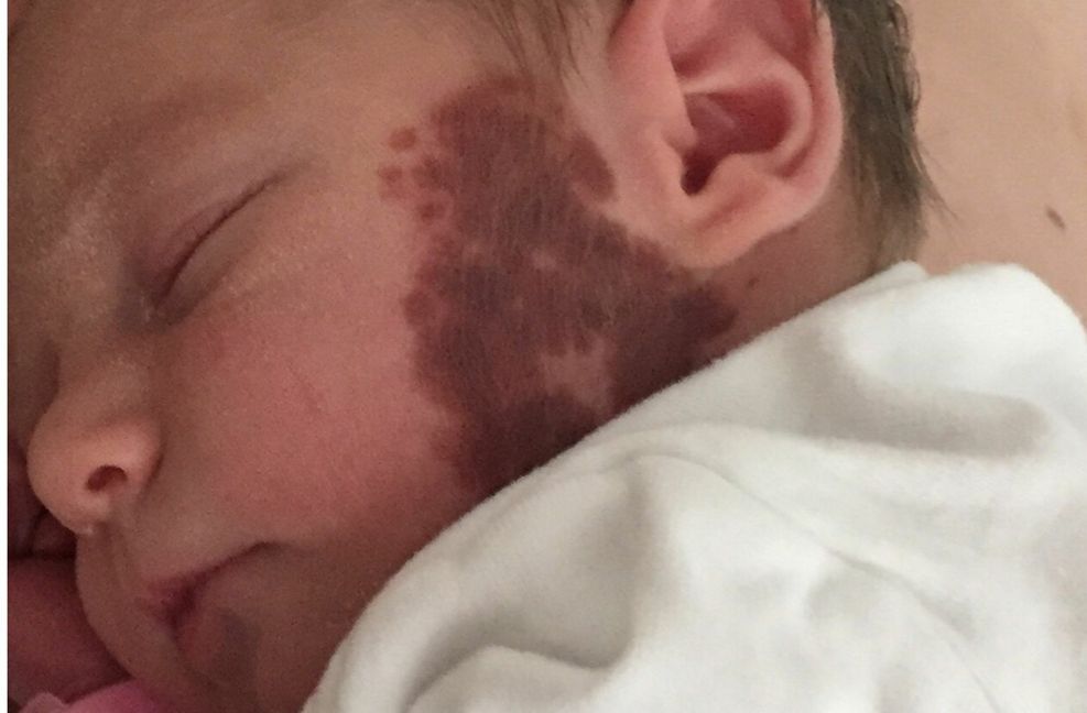 Ein Riesen-Muttermal kann ein gewisses gesundheitliches Risiko bergen, aber auch für die Kinder zum Stigma werden.
 Foto: Uniklinik /Tübingen